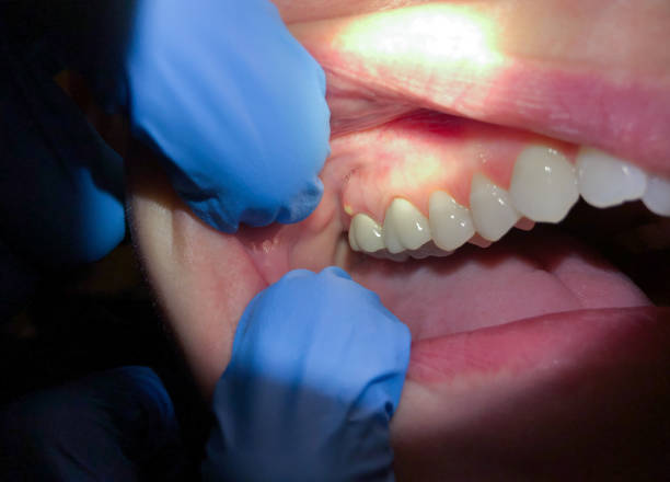 Best Emergency Dental Care for Abscessed Tooth in Elon, NC